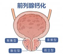 查出前列腺钙化灶怎么办